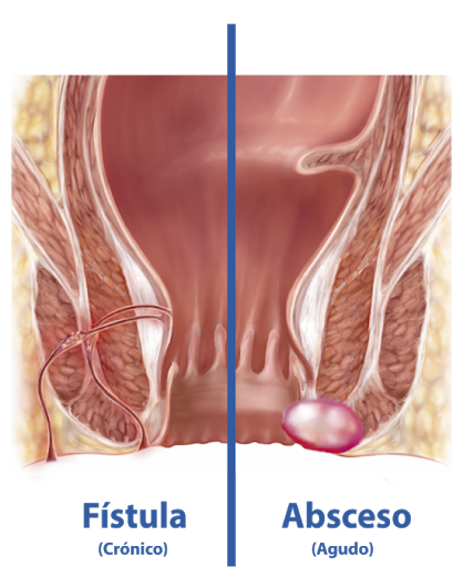 Cómo hacer baños de asiento para fístula anal - Dra Milagros Quinto