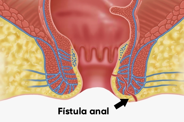 fistula-anal