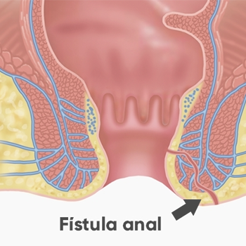 Fistula Anal