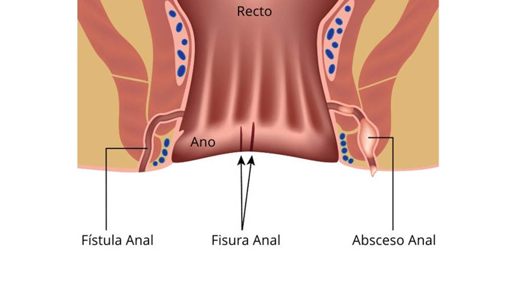 fisura anal lima